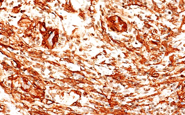 20E3 ATRT (NP24-888) A2 SMA 40X 3