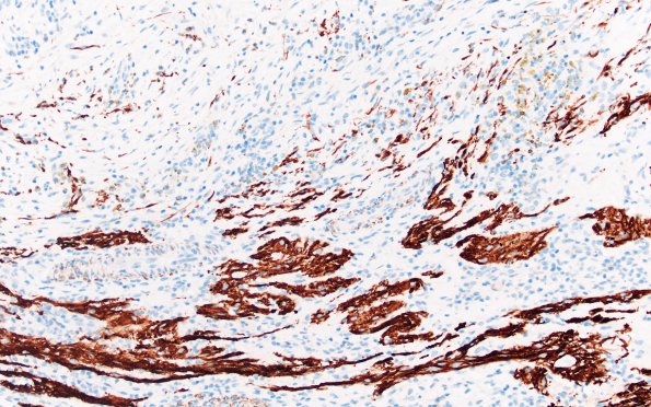 20F1 ATRT (NP24-888) A2 Desmin 20X 2