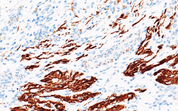 20F2 ATRT (NP24-888) A2 Desmin 40X 2