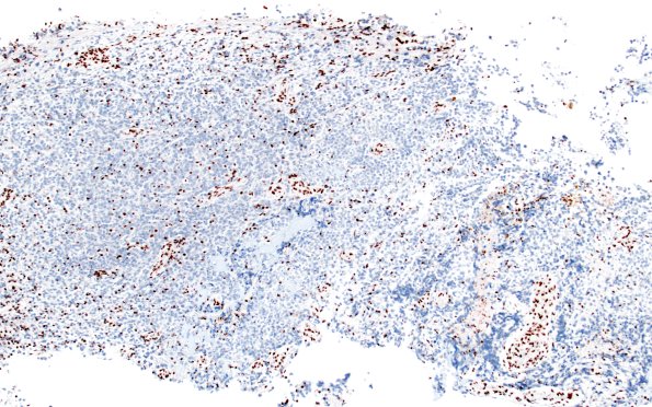 20G1 ATRT (NP24-888) A2 INI1 10X 2