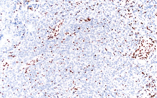 20G2 ATRT (NP24-888) A2 INI1 20X 1