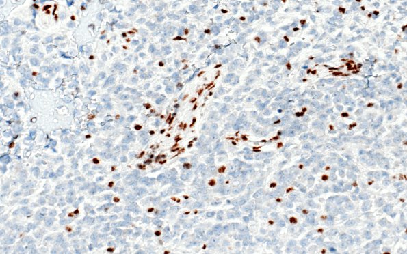 20G4 ATRT (NP24-888) A2 INI1 40X 3