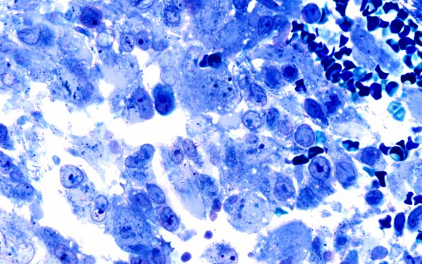 2B1 AT-RT (Case 2) H&E 100X 3