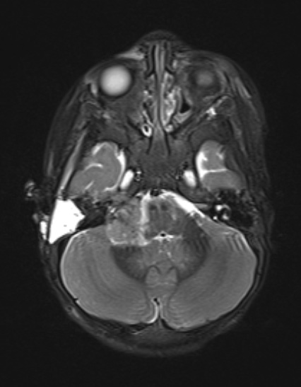 3A1 ATRT (Case 3) STIR - Copy