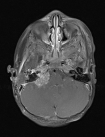 3A2 ATRT (Case 3) T1 W - Copy