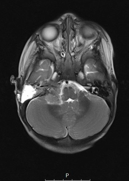 3A3 ATRT (Case 3) T2 W - Copy