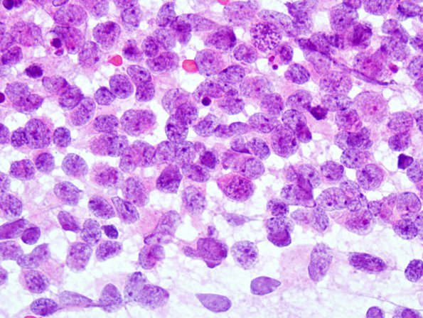 4B1 ATRT (Case 4) Smear 1.jpg