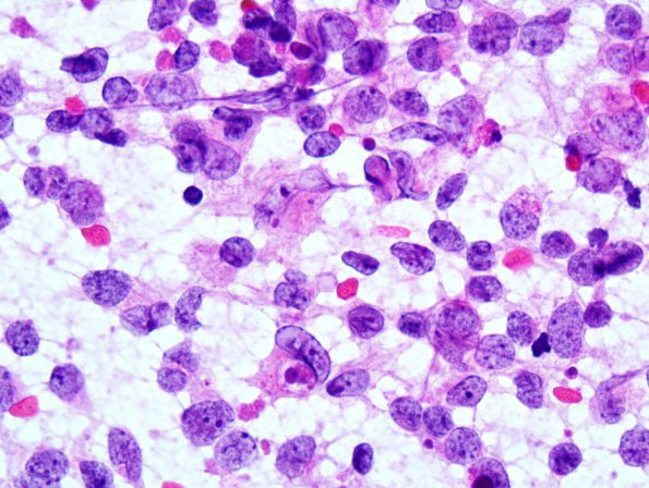 4B2 ATRT (Case 4) Smear 2.jpg