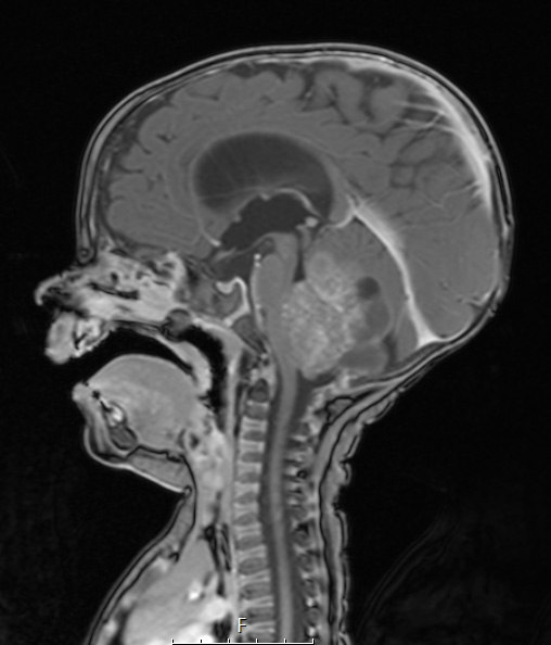 5A1 ATRT (Case 5) T1W - Copy