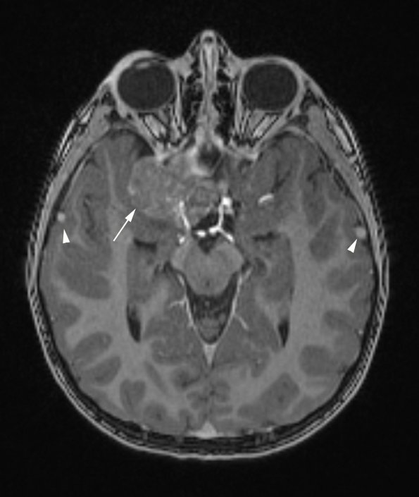 6A1 AT-RT (ATRT, Case 6) T1W 1 copy - Copy