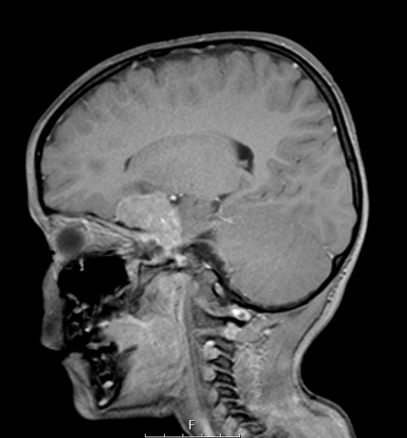 6A2 AT-RT (ATRT, Case 6) T1W 2 - Copy