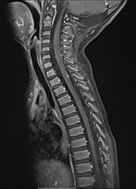 6A3 AT-RT (ATRT, Case 6) T1W 3 - Copy