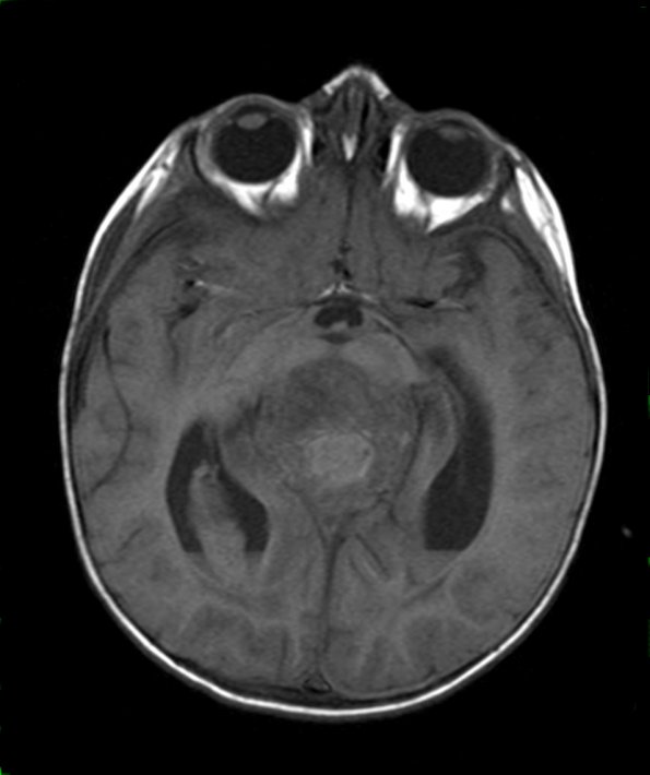 7A2 AT-RT (Case 7) T1 1 - Copy