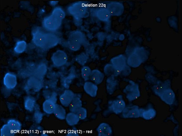 7H AT-RT (Case 7) p22 loss - Copy