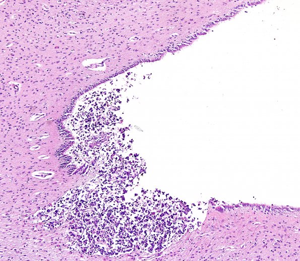 9C5 ATRT (Case 9) H&E 6.jpg