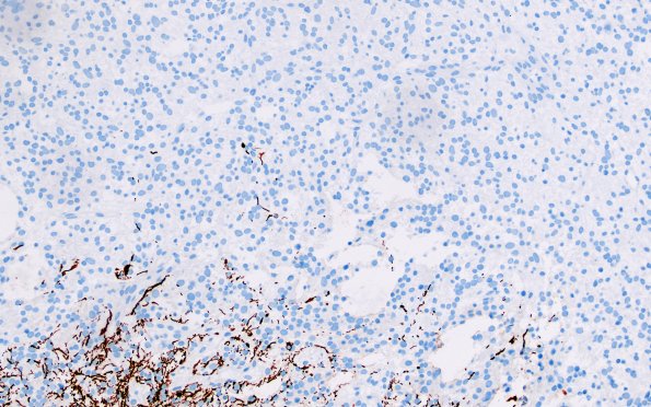 1L BCOR (Case 1) GFAP 1