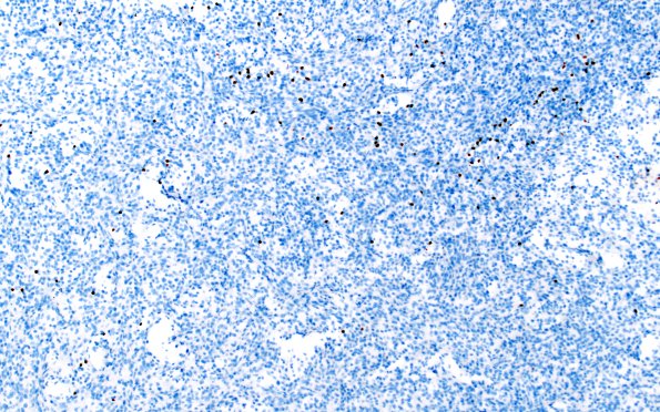 1M1 BCOR (Case 1) Olig 2