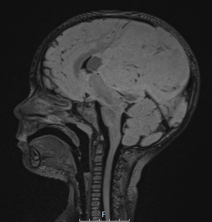 1A1 ETMR (NP20-592) FLAIR noC SAG - Copy