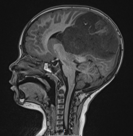 1A2 ETMR (NP20-592) T1 noC SAG - Copy