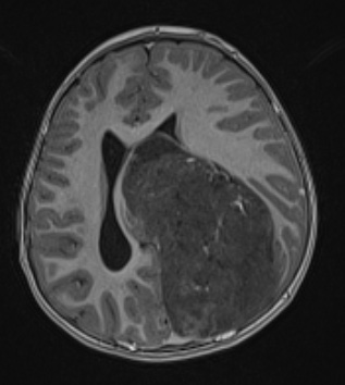 1A4 ETMR (NP20-592) T1w axial - Copy