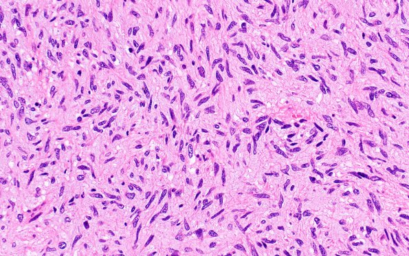 1B12 ETMR, C19MC altered (NP20--592) H&E 40X 2