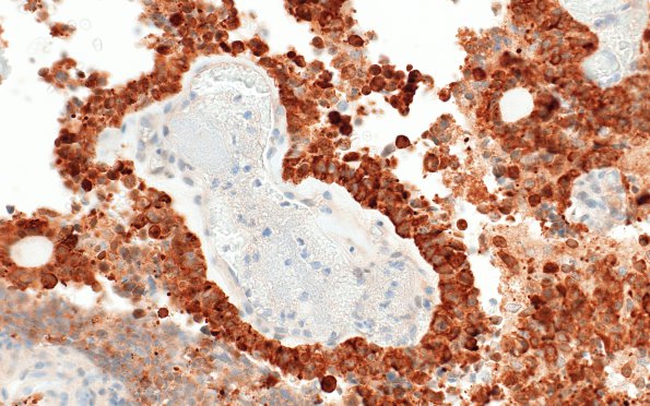 1I2 ETMR, C19MC altered (Case 1) IN28A 1