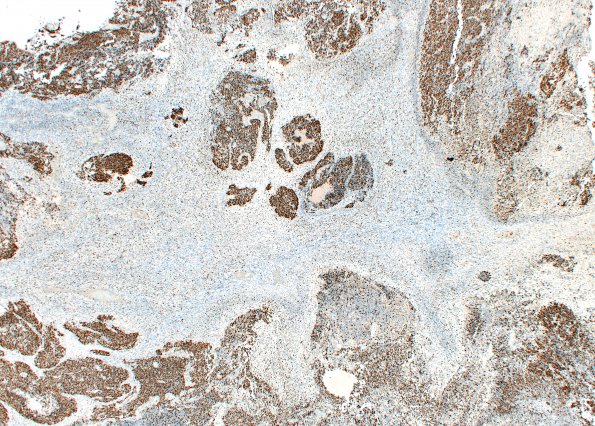 1J1 ETMR, C19MC altered (Case 1) Ki67 6