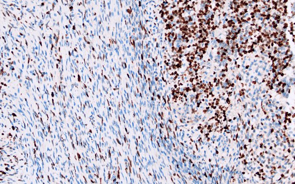 1J2 ETMR, C19MC altered (Case 1) Ki67 1