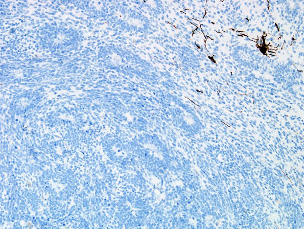 2C ETANTR (Case 2) GFAP 3