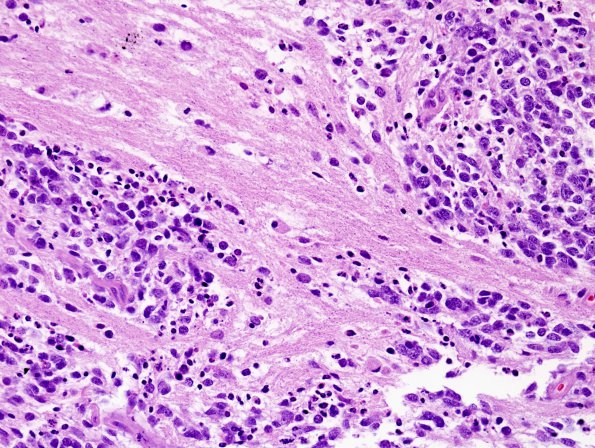 3A13 ETANTR (Case 3) H&E 37.jpg