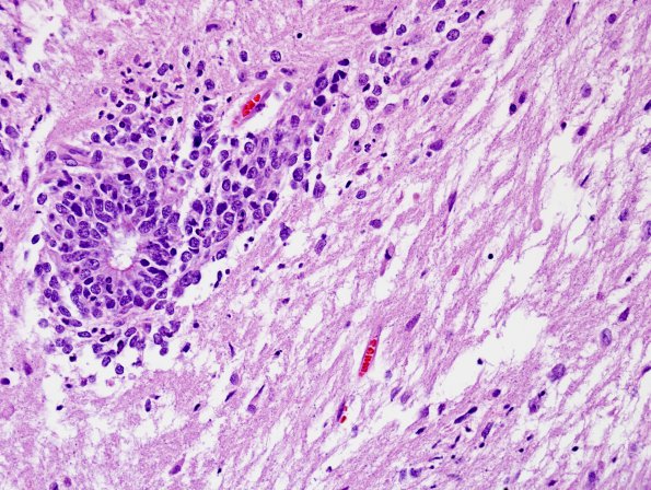 3A3 ETANTR (Case 3) H&E 40.jpg