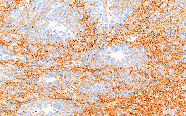 4B2 ETANTR (Case 4) SYN 40X