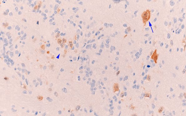 4D2 ETANTR (Case 4) Neu-N 40X copy