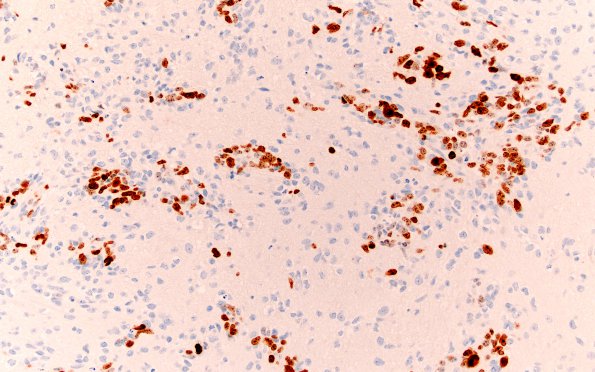 4F2 ETANTR (Case 4) Ki67 20X