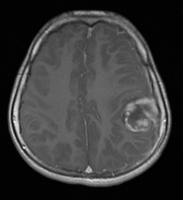 5A1 ETANTR (Case 5) T1W 1 - Copy