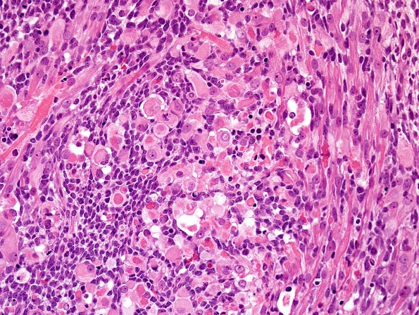 5B9 ETMR (Case 5) Area A rhabdo H&E 1.jpg