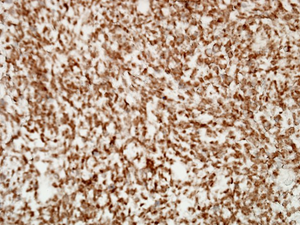 5I ETMR (Case 5) INI1.jpg