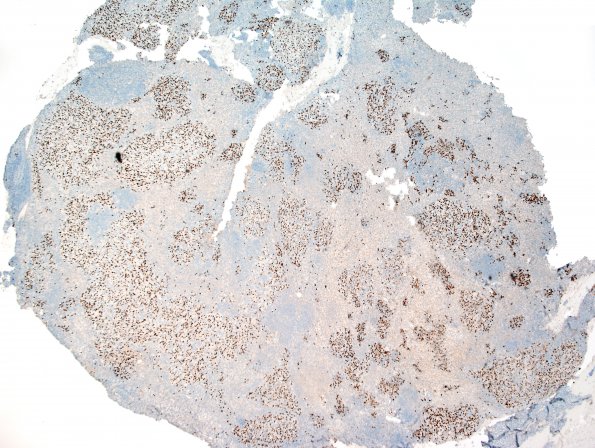 5K1 ETMR (Case 5) Area A rhabdo Myogenin 4X.jpg