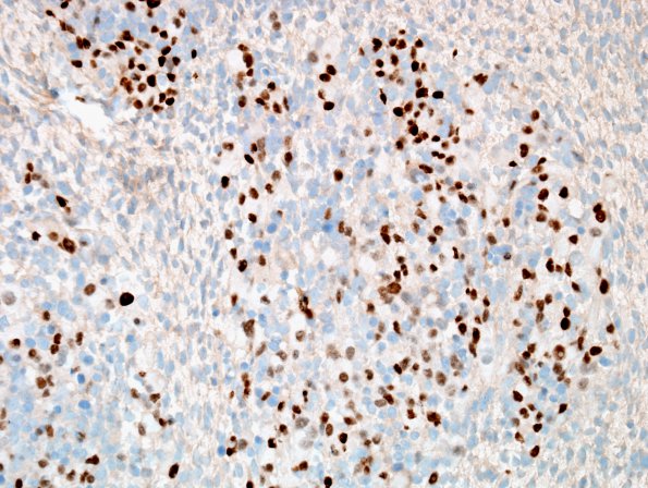 5K2 ETMR (Case 5) Area A rhabdo Myogenin 3.jpg