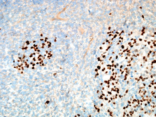 5K3 ETMR (Case 5) Area A rhabdo Myogenin 2.jpg