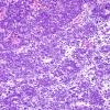 6A1 ETANTR, medulloepithelioma (Case 6) H&E 7.jpg