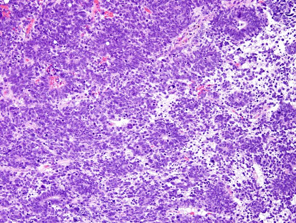 6A1 ETANTR, medulloepithelioma (Case 6) H&E 7.jpg