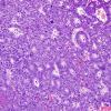 6A2 ETANTR, medulloepithelioma (Case 6) H&E 4.jpg