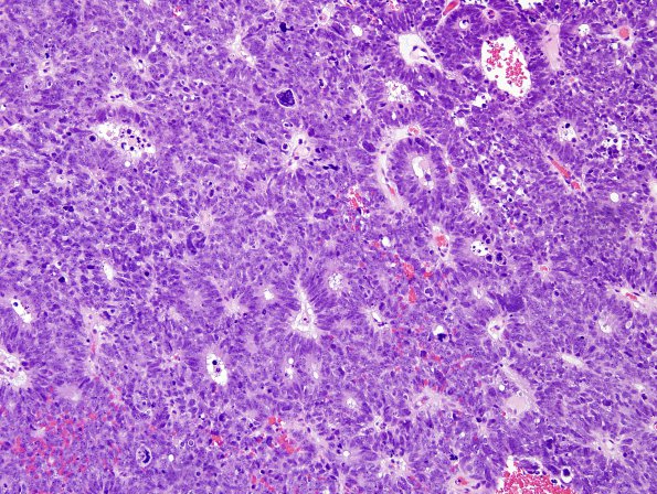 6A2 ETANTR, medulloepithelioma (Case 6) H&E 4.jpg