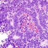 6A3 ETANTR, medulloepithelioma (Case 6) H&E 2.jpg