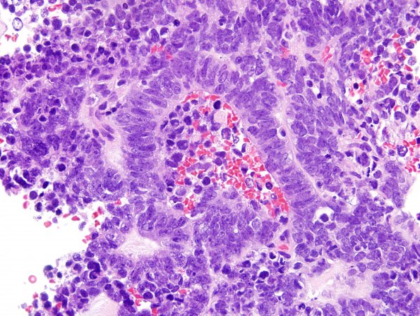 6A3 ETANTR, medulloepithelioma (Case 6) H&E 2.jpg