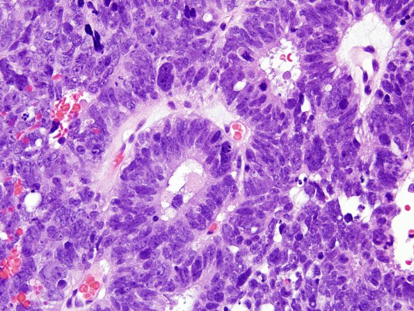 6A4 ETANTR, medulloepithelioma (Case 6) H&E 6.jpg