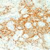 6B ETANTR, medulloepithelioma (Case 6) SYN 1.jpg