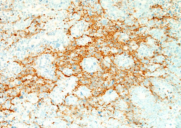 6B ETANTR, medulloepithelioma (Case 6) SYN 1.jpg