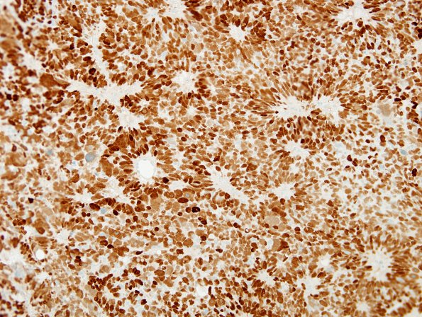 6C ETANTR, medulloepithelioma (Case 6) p53 1.jpg